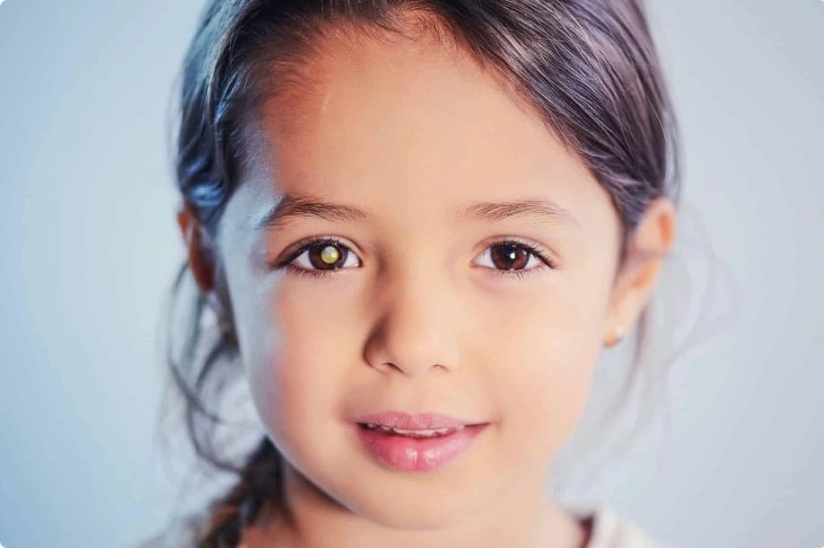 Child showing symptoms of Retinoblastoma